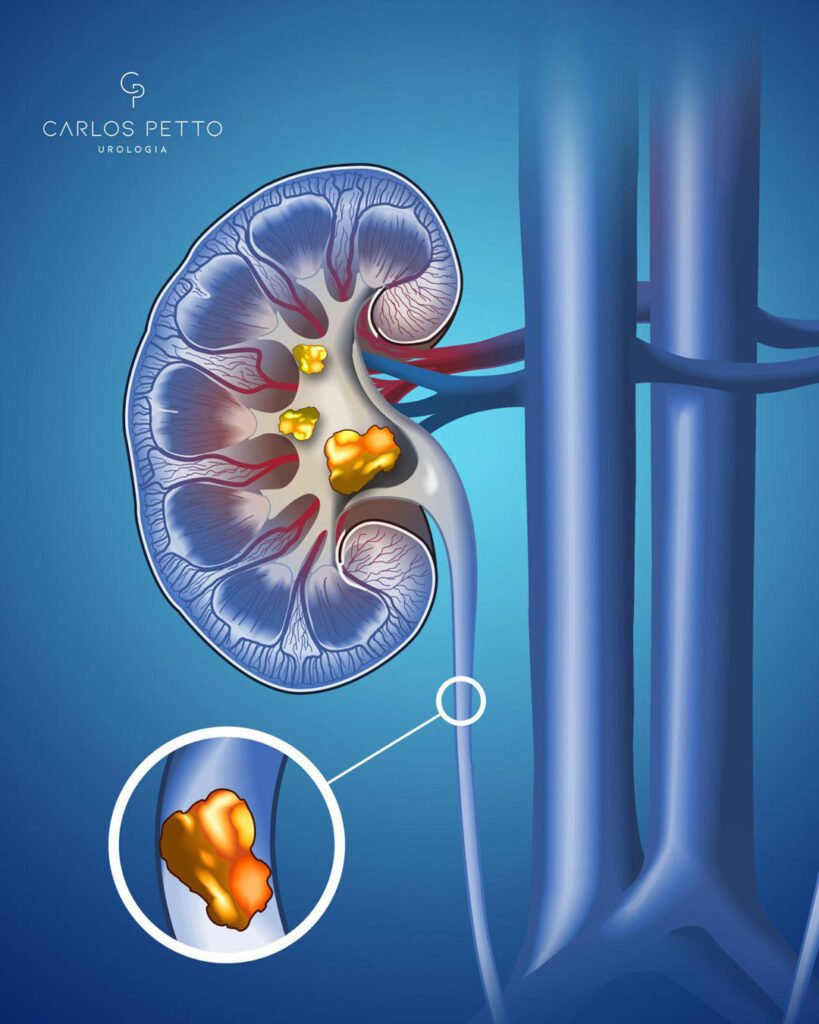 Cálculos Renais: quando a pedra atinge o ureter.