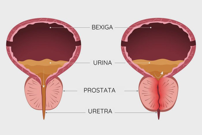 Hiperplasia Prostática Benigna (HPB)